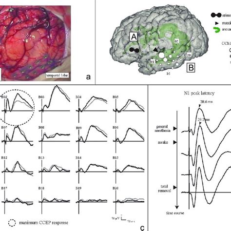 Typical Configuration Of Cortico Cortical Evoked Potentials Cceps