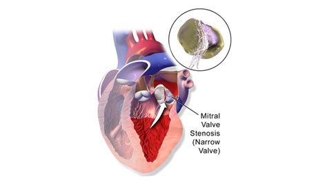 Mitral Stenosis Measurements