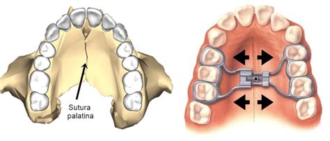 Ortopedia Maxilar Indicaciones Y Precios Soluci N Dental