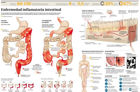 Enfermedad De Crohn Y Colitis Ulcerosa