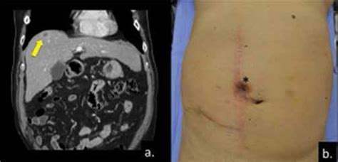 Scielo Brasil Laparoscopic Transthoracic Liver Resection