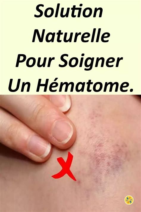 Soigner un Hématome Rapidement avec un Remède Naturel Hématome