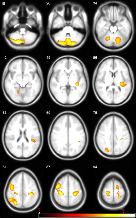 Regions Of Statistically Significant Gray Matter Decrease In Anorexic