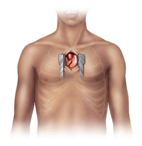 Aortic Stenosis Anatomy Diagnosis Treatment - The Valve Clinic