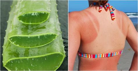 3 Ways To Use Aloe Vera To Heal A Sunburn Fast