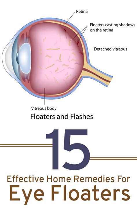 Natural remedies for eye floaters causes prevention tips – Artofit