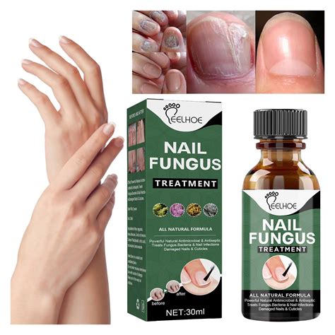 Toenail Fungus Treatment Foot Fungus Treatment Extra Strength Fungus