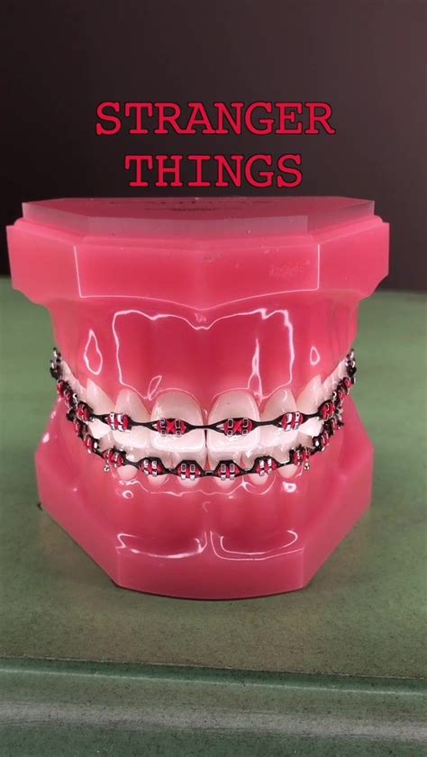 The Braces Guy On Tiktok Braces Teeth Colors Dental Braces Colors