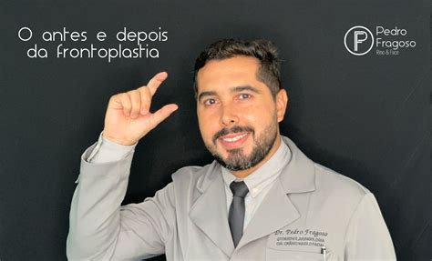 O Antes E Depois Da Frontoplastia Dr Pedro Fragoso