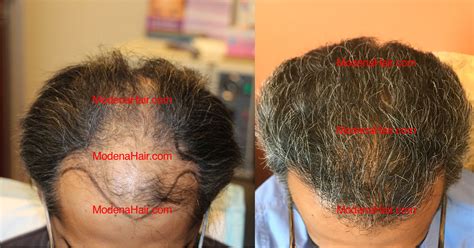 Case Study Fut Hair Transplant Months Post Op Modena Hair Institute