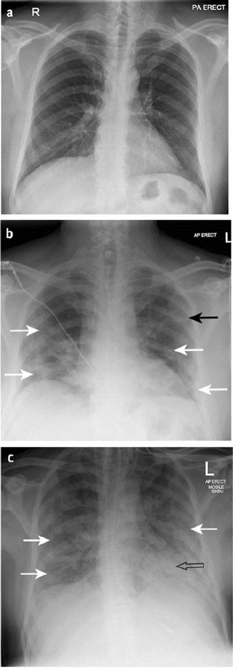 A Normal Posterior Anterior Chest Radiograph [4] Of Patient A Man