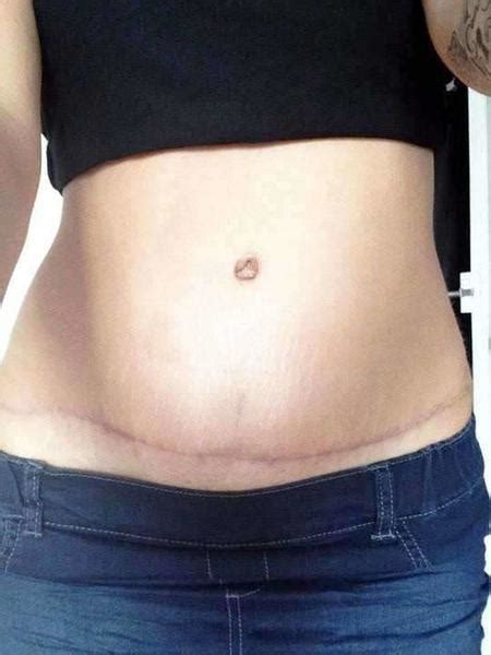 Tummy Tuck Scar Tummy Tuck Information Prices Photos Reviews Qanda