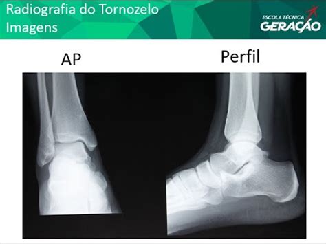 Radiografia Do Tornozelo Ap Perfil Youtube