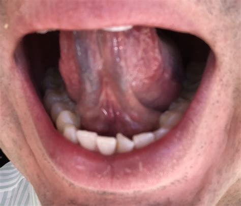 Tongue Tie Diagnosis Daniel Lopez D O