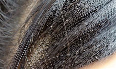 Head Lice Definition Of Head Lice