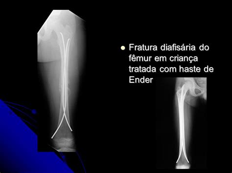 Fratura Do F Mur Fraturas Diafis Ria Ppt Carregar