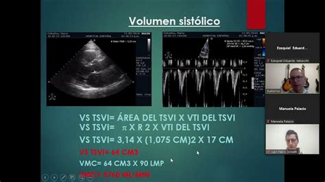 Estenosis Aortica Severa Youtube