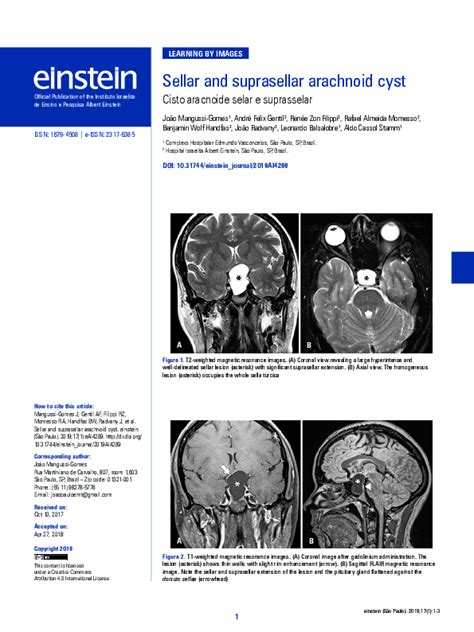 (PDF) Sellar and suprasellar arachnoid cyst | Journal einstein (São ...