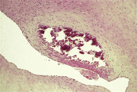 Fetal Thrombotic Vasculopathy Surgical Pathology Clinics