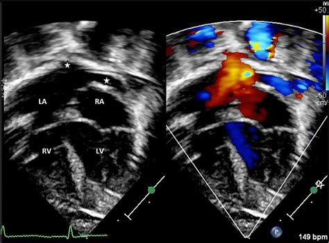 Apical Four Chamber View On Postnatal Transthoracic Echocardiography