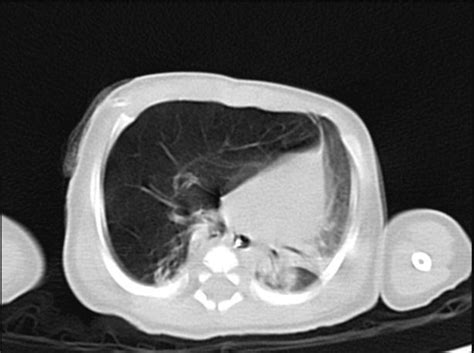 Figure 3 From Congenital Lobar Emphysema Of Right Middle Lobe