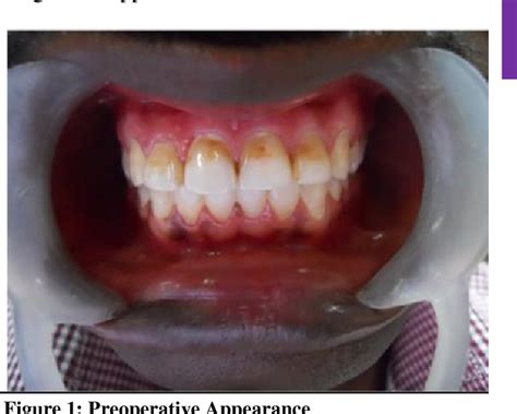 Figure 1 From Aesthetic Management Of Enamel Defects With Microabrasion