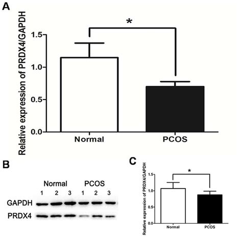 Expressions Of Prdx Mrna And Protein In Normal Ovaries And Pcos