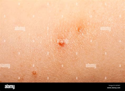 Molusco Contagioso Tratramiento Fotografías E Imágenes De Alta