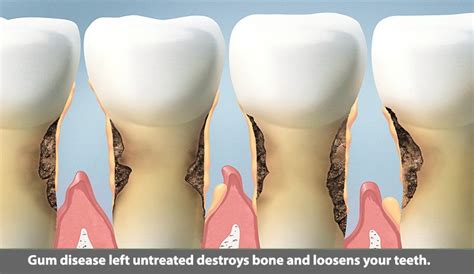 Vertical Bone Loss – The Pasadena Dentist: Michael Nugent DDS