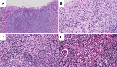 Extranodal Marginal Zone Lymphoma In Gastric Malt Lymphoma The Mucosa