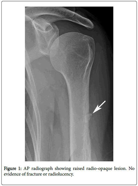 Journal Of Orthopedic Oncology Case Report Acute Calcific Tendonitis