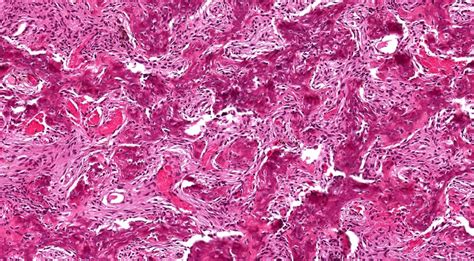 Ossifying Fibroma Histology