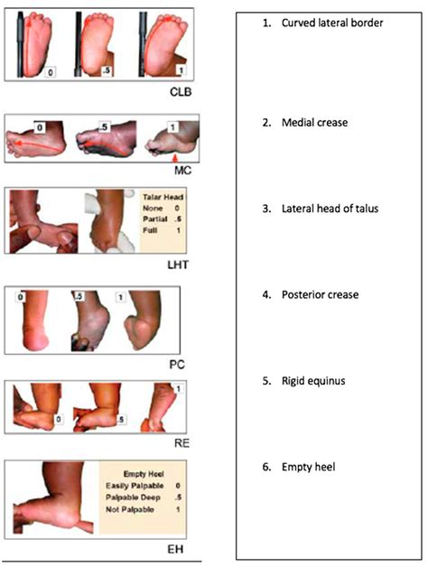 Ponseti Method Manipulation