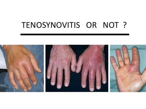 Flexor Tenosynovitis Thumb