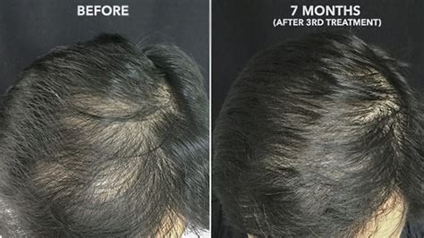 Prf Hair Restoration Bel Lavi Medical Aesthetics