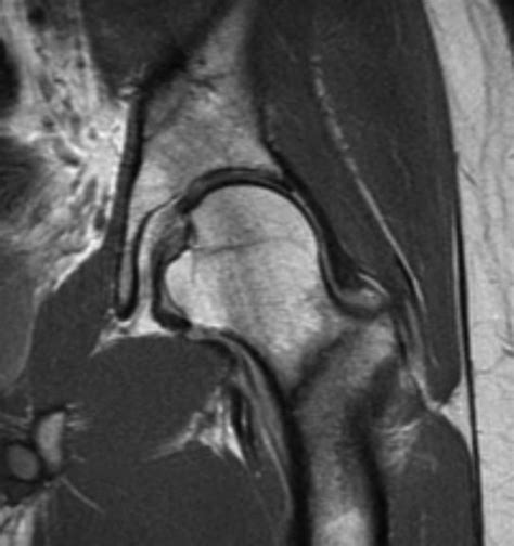 Stress Fracture Of The Femoral Neck Robert Howells