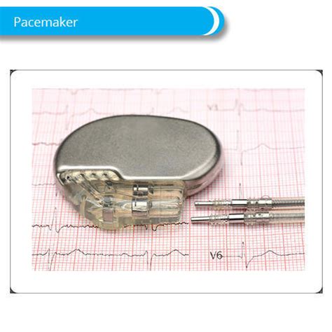 Hospital Usage Cardiac Pacemaker To Help Control Abnormal Heart Rhythms