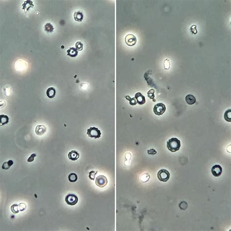 Loads of dysmorphic erythrocytes in a pat w IgA nephropathy. Phase ...