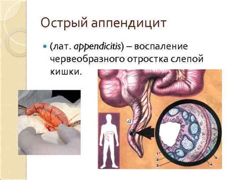Острый аппендицит 2014 г Никифорчин Андрей студент 614