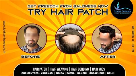 Best Hair Patch In Patna Bihar हेयर विग राँची Hair Patch Patna