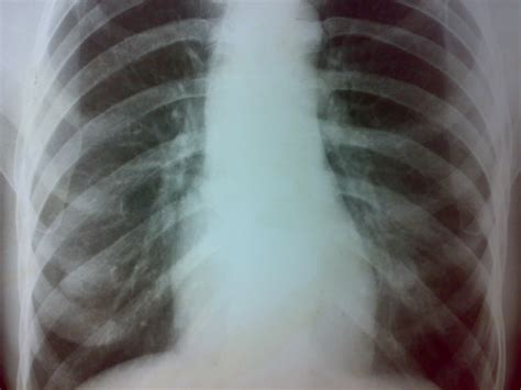 Esophageal cancer current treatment | Respiratory tract disorders and ...