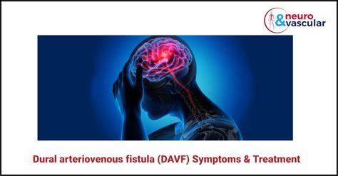 Dural arteriovenous fistula (DAVF) Symptoms and Treatment