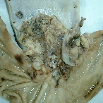 Gross Examination Of Resected Specimen Shows Ulcerated Carcinoma In