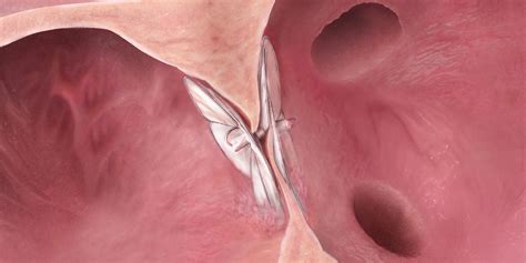 Gore Cardioform Septal Occluder Gore Medical Asia Pacific