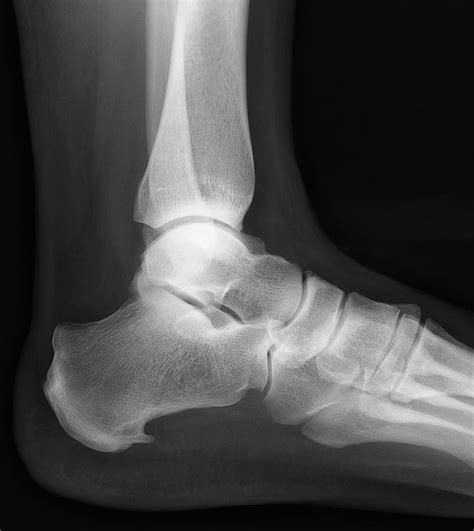 Calcaneus Stress Fracture Mri Ph