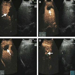 Prerfa Contrastenhanced Ultrasonography Of Recurrent Icc Notes