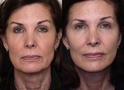 Facelift Before And After Pictures Case 15 Atlanta Georgia