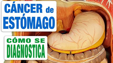 Cáncer De Estómago Diagnóstico Youtube