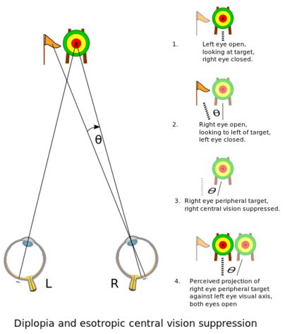 Diplopia - Physiopedia