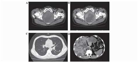 Small Cell Carcinoma Of The Rectum A Report Of Imaging Results From